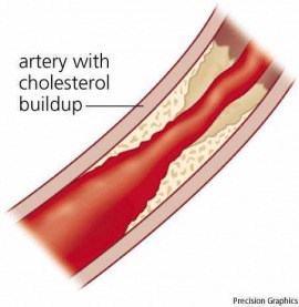 atherosclerosis