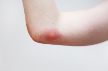 An example of an aculei is a bee's sting. An example of an aculei is a bee's sting.