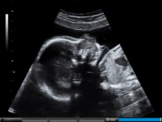 An ultrasonic image of a fetus. An ultrasonic image of a fetus.