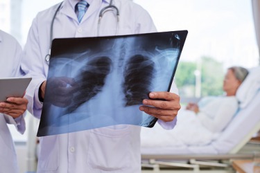 A doctor looking at a chest Xray to assess if his patient has pneumonia. A doctor looking at a chest Xray to assess if his patient has pneumonia.