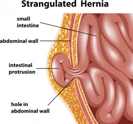 A diagram of a protrusion of the intestines. A diagram of a protrusion of the intestines.