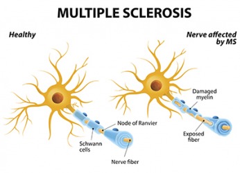 Multiple sclerosis damages the myelin that protects nerves and then forms scar tissue which causes various symptoms to occur. Multiple sclerosis damages the myelin that protects nerves and then forms scar tissue which causes various symptoms to occur.