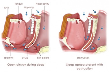 Diagram of obstructive sleep apnea. Diagram of obstructive sleep apnea.
