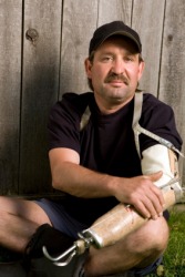 An amputee with artificial arm. An amputee with artificial arm.