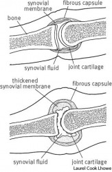 arthritis top: healthy finger joint; arthritis top: healthy finger joint;