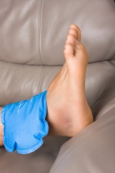 A compress placed on an injured ankle. A compress placed on an injured ankle.