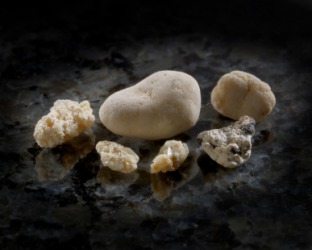 A collection of kidney stones. A collection of kidney stones.