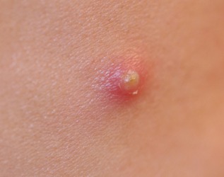 This pimple is an example of an abscess. This pimple is an example of an abscess.