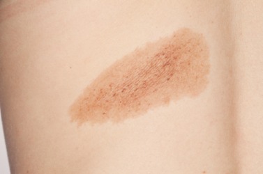 This mole could be a carcinoma. This mole could be a carcinoma.