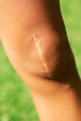 A scar from knee surgery. A scar from knee surgery.