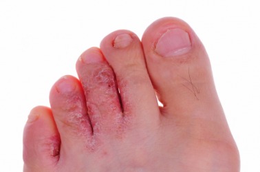 A foot infected with athlete's foot. A foot infected with athlete's foot.