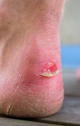 This person has a bad blister on their heel. This person has a bad blister on their heel.