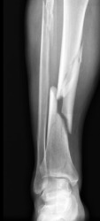 This x-ray reveals a fractured leg. This x-ray reveals a fractured leg.