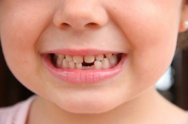 The gap where the missing tooth was is a lacuna. The gap where the missing tooth was is a lacuna.
