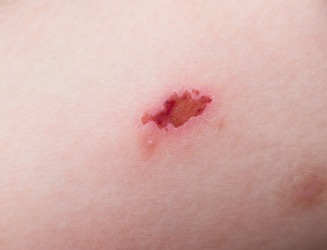 A scab formed over a mosquito bite. A scab formed over a mosquito bite.