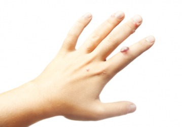 A hand with a large wart on the index finger. A hand with a large wart on the index finger.