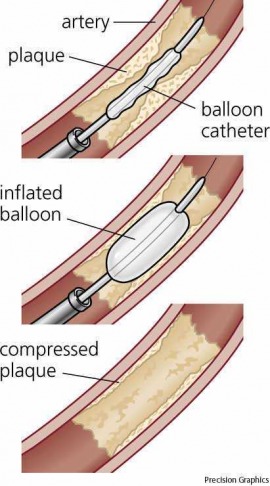 angioplasty