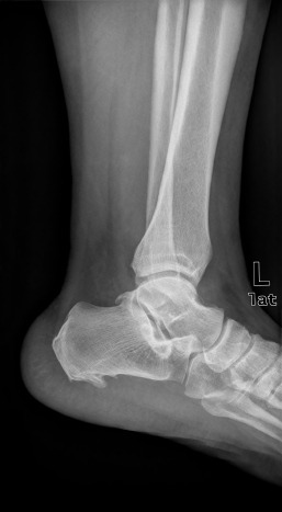 anklebone