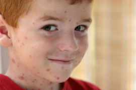 chickenpox