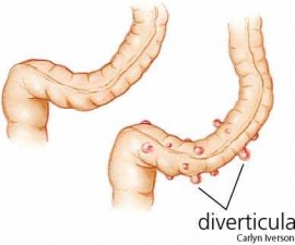 diverticulosis