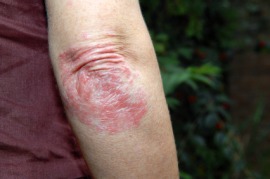 eczema