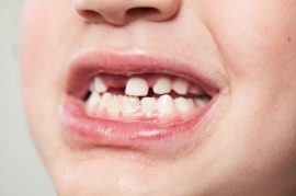 gaptoothed