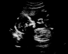 unborn