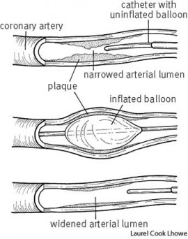 angioplasty