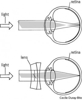 astigmatism