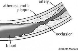 atherosclerosis