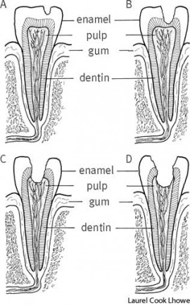 caries