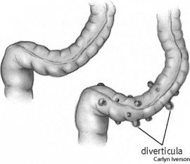 diverticulum
