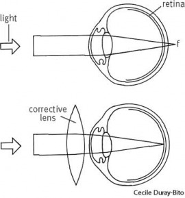 hyperopia
