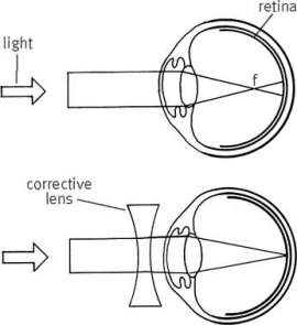 myopia