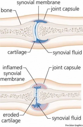 rheumatoid arthritis