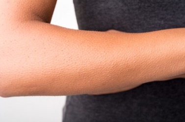 An arm covered with goose bumps. An arm covered with goose bumps.