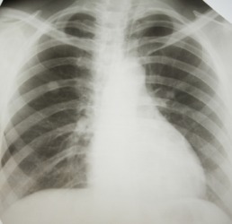 An x-ray of a person with lung cancer. An x-ray of a person with lung cancer.