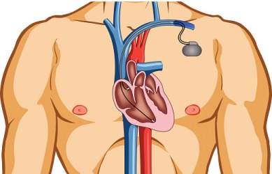 An illustration of pacemaker in the chest. An illustration of pacemaker in the chest.