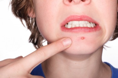 A girl pointing to a blemish on her chin. A girl pointing to a blemish on her chin.