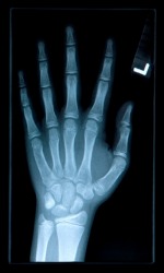 The Xray of a hand shows the phalanges of the fingers. The Xray of a hand shows the phalanges of the fingers.
