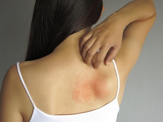 The rash on the woman's back is very itchy. The rash on the woman's back is very itchy.
