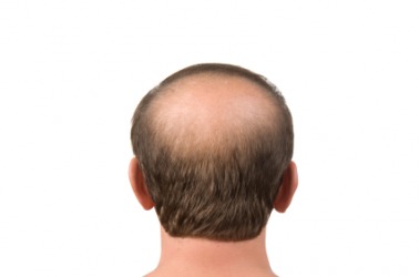 A mans head showing alopecia. A mans head showing alopecia.