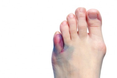 A foot with a large bruise. A foot with a large bruise.