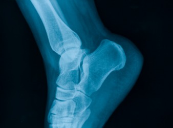 X-ray of the human foot showing the calcaneus bone. X-ray of the human foot showing the calcaneus bone.