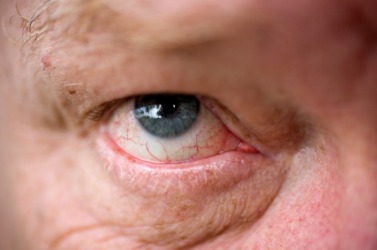 A close up of an eye showing the capillaries. A close up of an eye showing the capillaries.
