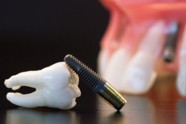 A dental implant. A dental implant.