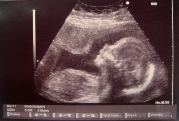 An ultrasound of a human fetus. An ultrasound of a human fetus.