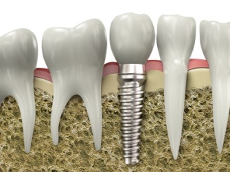 A dental implant. A dental implant.