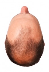 The head of a man who is balding. The head of a man who is balding.