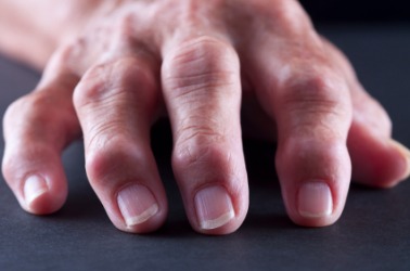These knuckles show the signs of arthritis. These knuckles show the signs of arthritis.